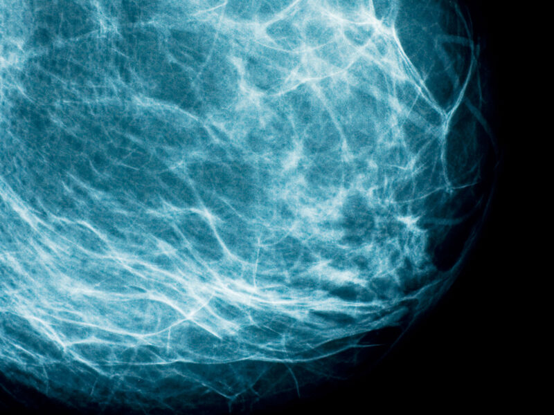 1800x1200 advanced breast cancer treatments