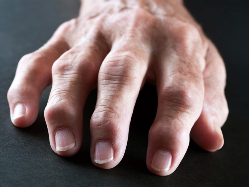 Injections of Your Own Fat Could Help Arthritic Hands 3 1800x1200 body parts you can damage by smoking slideshow