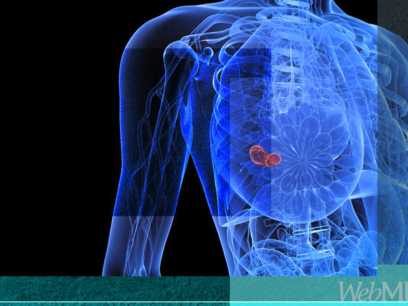 Obesity Drives Breast Cancer Risk for Black Women 2 1800x1200 funded basics breast cancer spreads video