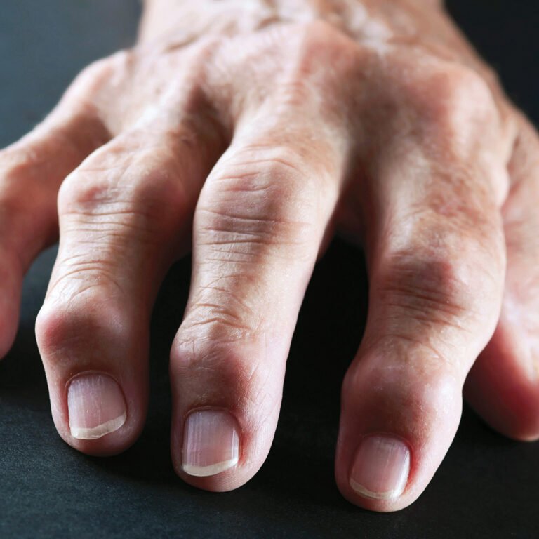 Ревматоидный артрит кистей рук фото