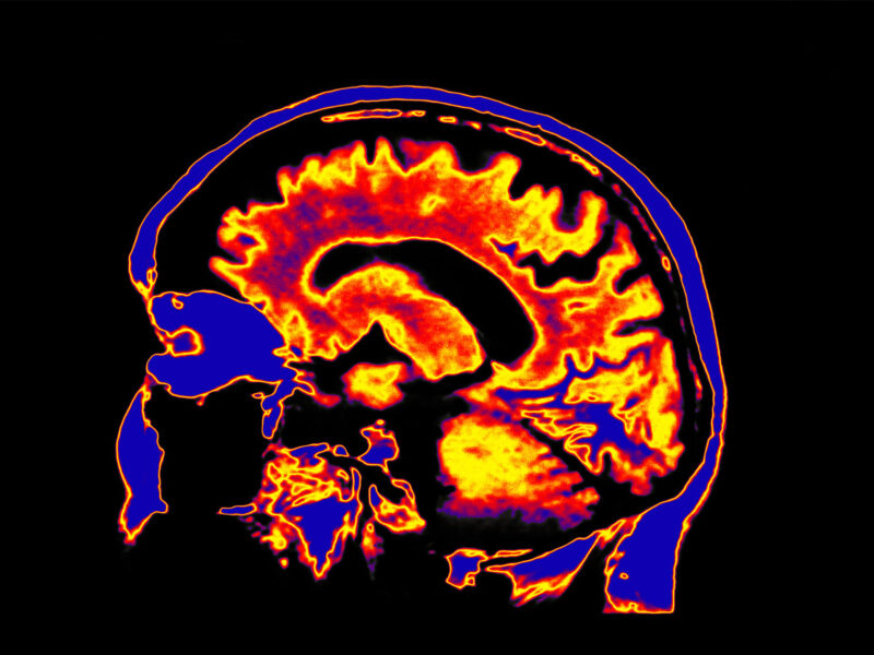 COVID Survival Declines When Brain Affected: Study 9 1800x1200 medical illustrations brain red orange black scan 01 other