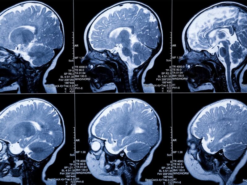 1800x1200 medical photo scan brain white black mri xray
