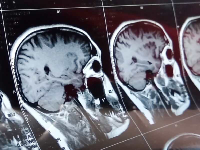 1800x1200 medical photo scan head brain xray 01 other