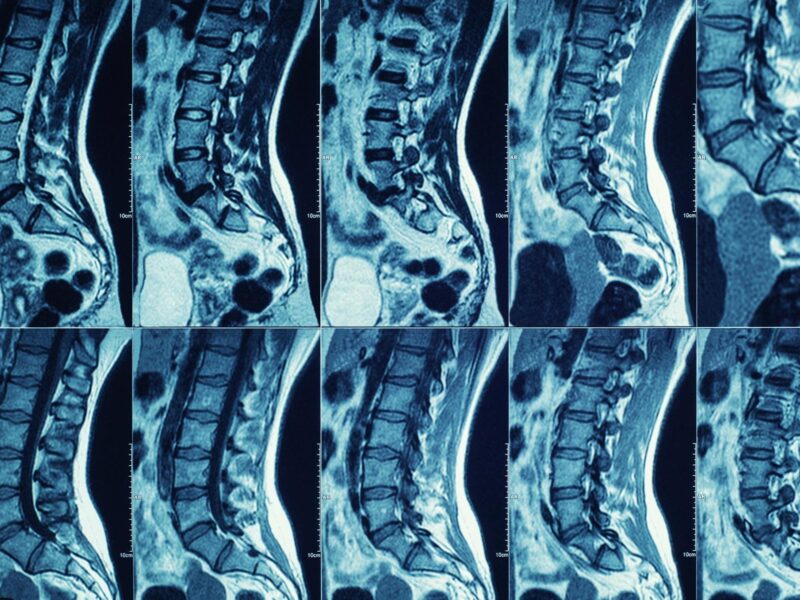 Finding Meaning and Joy After Spinal Cord Injury 3 1800x1200 medical photo scan spine back tail bone 01 other