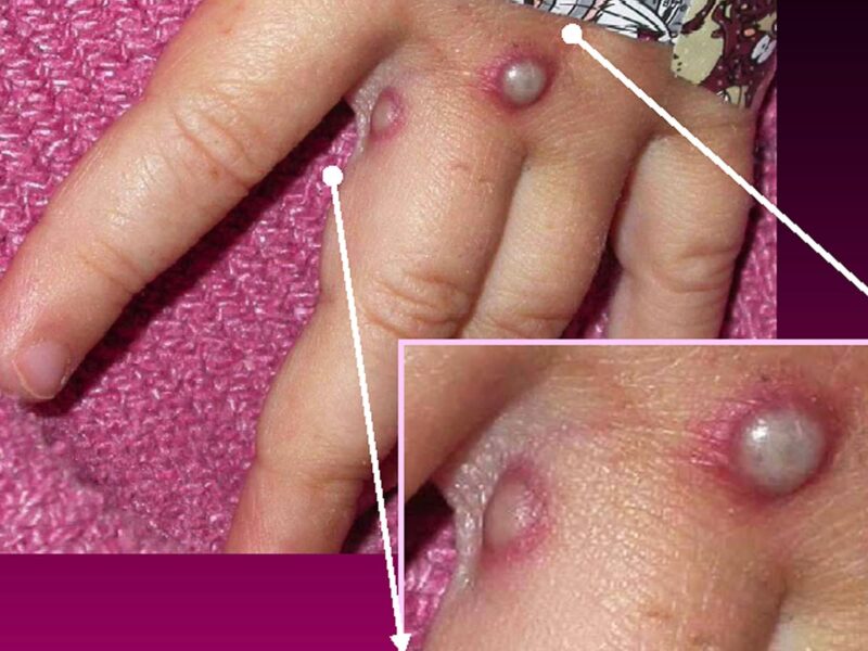 White House Announces New Response Actions 10 1800x1200 monkeypox lesions on hand other