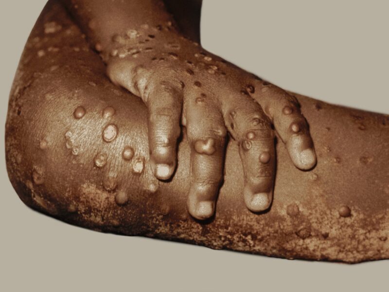 1800x1200 sciencesource rm monkeypox ref guide