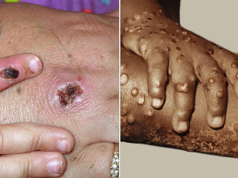 Global Monkeypox Cases Rise to More Than 550 3 1800x1200 sciencesource rm monkeypox ref guide alt