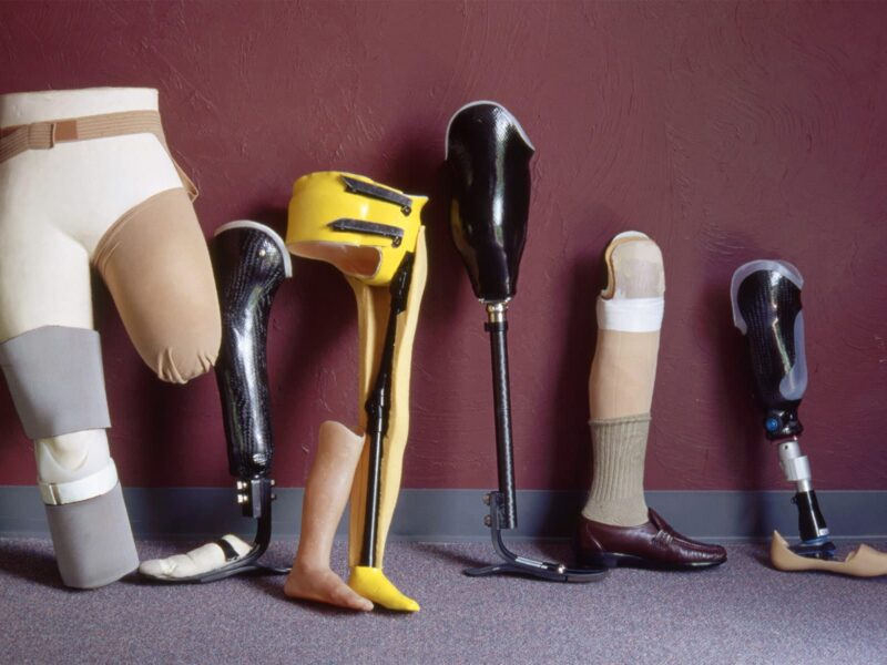 1800x1200 unsalvageable preventable amputations rise during covid prosthetics features