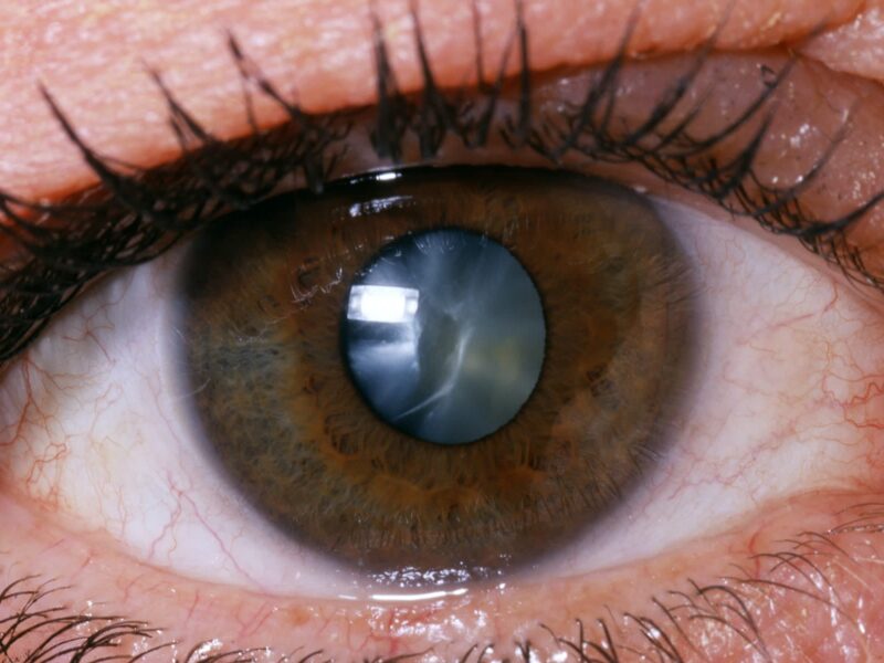 Cataract Surgery Might Lower Your Odds for Dementia 3 1800x1200 what to expect with cataract surgery slideshow